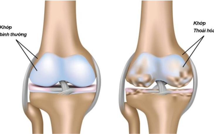 Đứt bán phần dây chằng chéo trước và sụn chêm ở người bệnh thoái hóa khớp gối