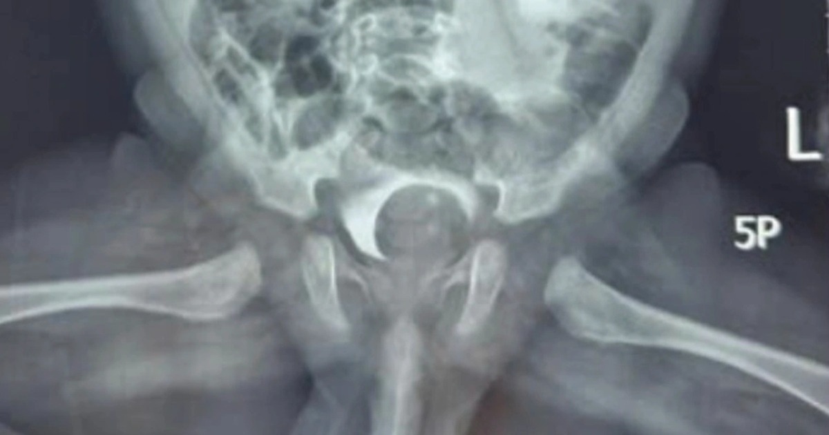 Ca mổ "lần đầu tiên" tại bệnh viện ở TPHCM cứu cháu bé 1 tháng tuổi