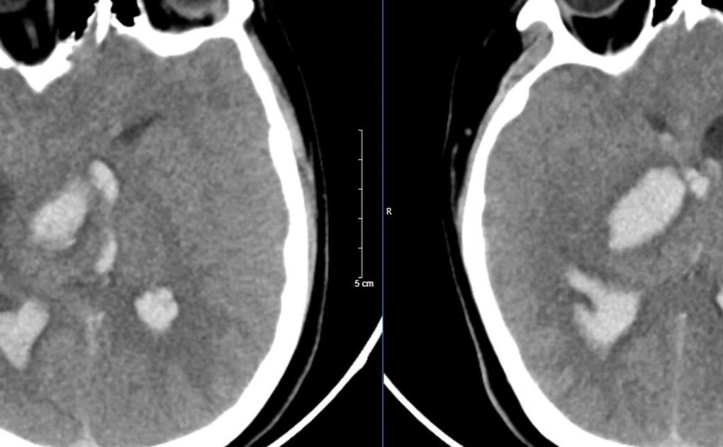 Nam sinh 15 tuổi tử vong sau cơn đau đầu dữ dội, cảnh báo bệnh nguy hiểm