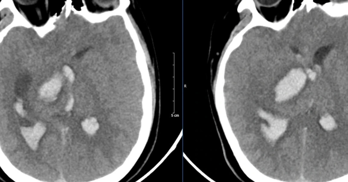 Nam sinh 15 tuổi tử vong sau cơn đau đầu dữ dội, cảnh báo bệnh nguy hiểm