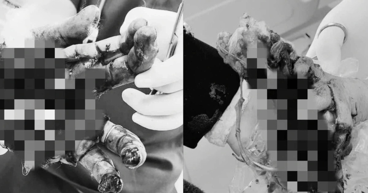 Người đàn ông dập nát 2 bàn tay nghi do pháo tự chế