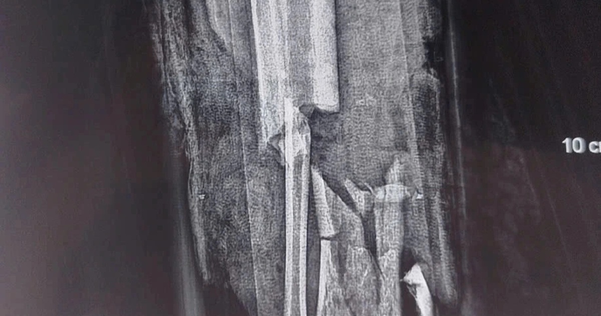 Nổ bình ga mini khi đang nấu ăn, người đàn ông cụt cẳng chân, mất ngón tay