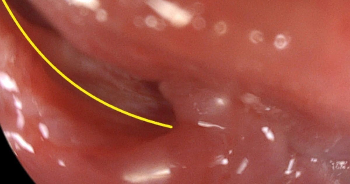 Nuốt thanh kiếm dài hơn 40cm, nam thanh niên bị đâm thủng thực quản