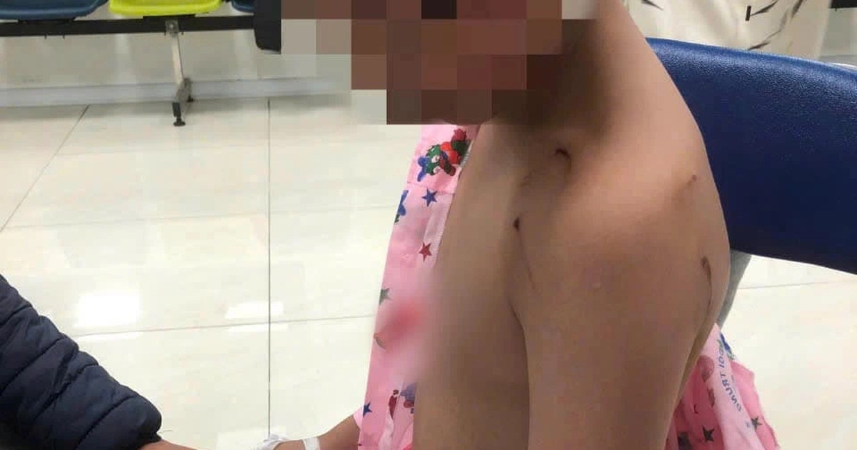 Hà Nội: Đi chúc Tết, bé trai bị chó cắn phải khâu 9 mũi