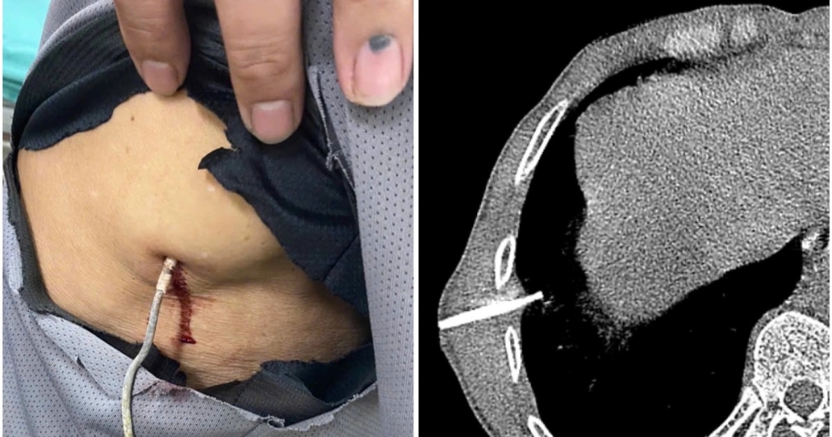 Người đàn ông bị dây kẽm dài 20cm xuyên vào lồng ngực