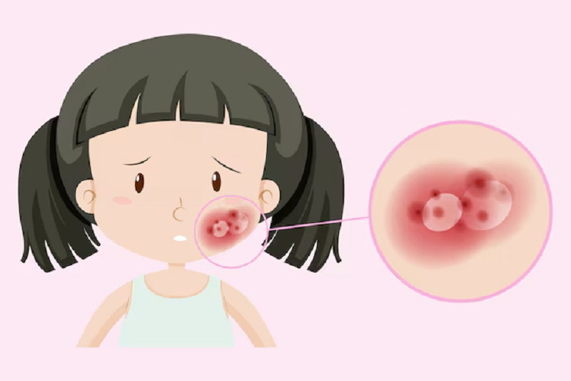Bài thuốc nam trị zona: Giải pháp tự nhiên hiệu quả từ lá cây Đặc điểm nhận dạng zona thần kinh