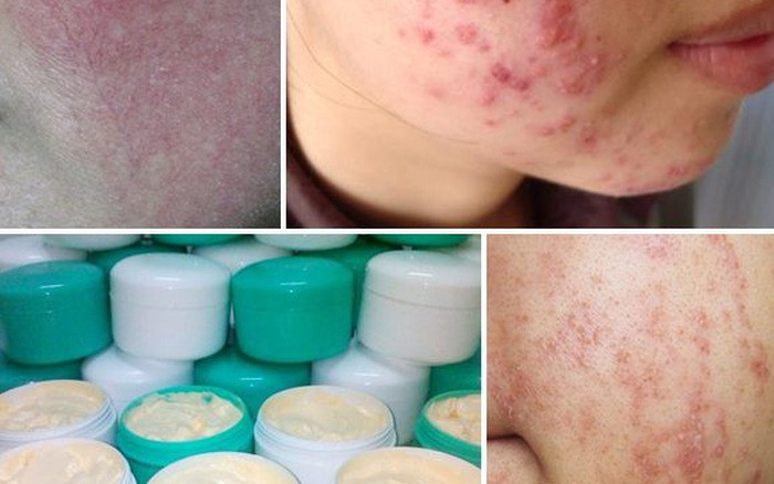 Thuốc Nam Chứa Corticoid: Hiểm Họa Khôn Lường Hậu quả trên da do sử dụng kem trộn chứa corticoid