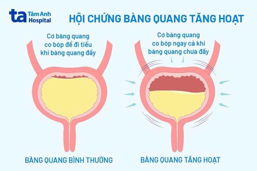 Thuốc Nam Chữa Bàng Quang Tăng Hoạt: Giải Pháp An Toàn và Hiệu Quả hình ảnh minh họa hội chứng bàng quang tăng hoạt