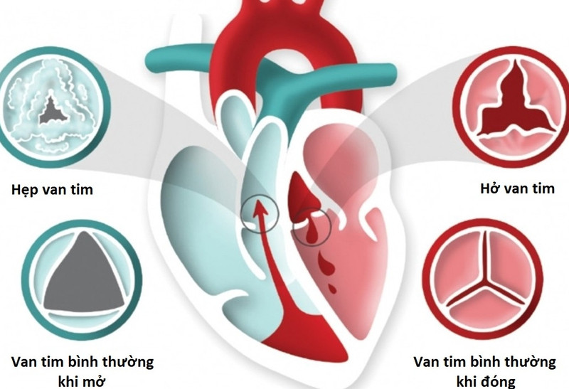Bài Thuốc Nam Chữa Bệnh Hở Van Tim: Hiệu Quả và An Toàn Nguyên nhân gây ra bệnh hở van tim