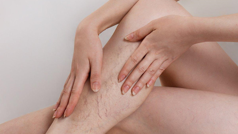 Bài thuốc nam trị giãn tĩnh mạch chân: Giải pháp tự nhiên hiệu quả Suy giãn tĩnh mạch chân