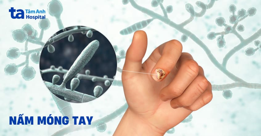 Thuốc Nấm Móng Tay: Giải Pháp Hiệu Quả Cho Vấn Đề Về Móng Thuốc nấm móng tay giúp giải quyết hiệu quả tình trạng nhiễm trùng móng