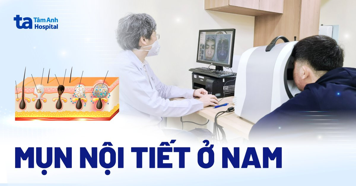 Thuốc uống nội tiết tố nam: Giải pháp điều trị mụn nội tiết hiệu quả Thuốc uống nội tiết tố nam