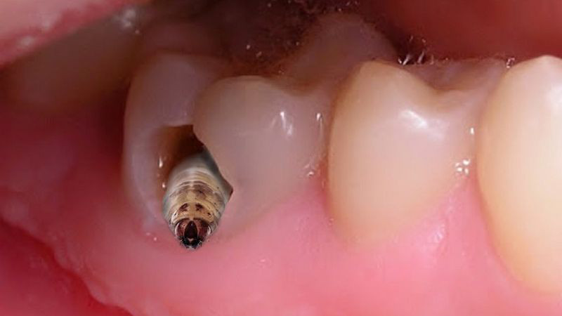 Thuốc Nam Ngậm Chắc Răng: Giải Pháp Tự Nhiên Cho Răng Lung Lay Viêm nha chu gây tổn thương mô xung quanh răng