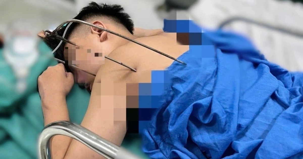 Cứu Sống Nam Thanh Niên 17 Tuổi Bị Dị Vật Đâm Thấu Tim Tại Hà Nội Dị vật 3 càng đâm thấu tim nam thanh niên 17 tuổi ở Hà Nội