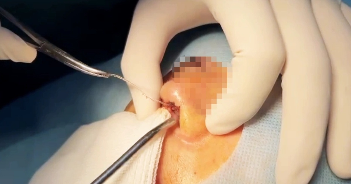 Cô gái 28 tuổi nguy kịch trong lúc phẫu thuật thẩm mỹ nâng mũi ở TPHCM Cô gái 28 tuổi nguy kịch trong lúc phẫu thuật thẩm mỹ nâng mũi ở TPHCM