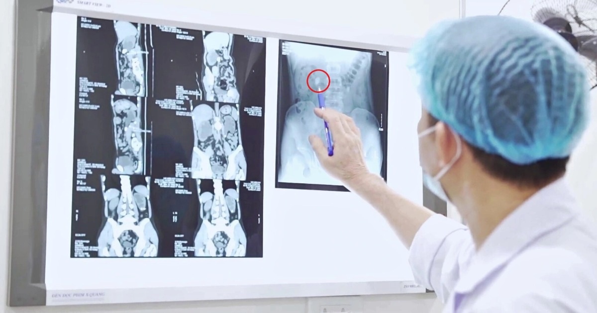 Cứu Hai Quả Thận Khỏi Bờ Vực Suy Thận Từ Biến Chứng Giãn Nặng Cứu hai quả thận khỏi "bờ vực" suy thận từ biến chứng giãn nặng