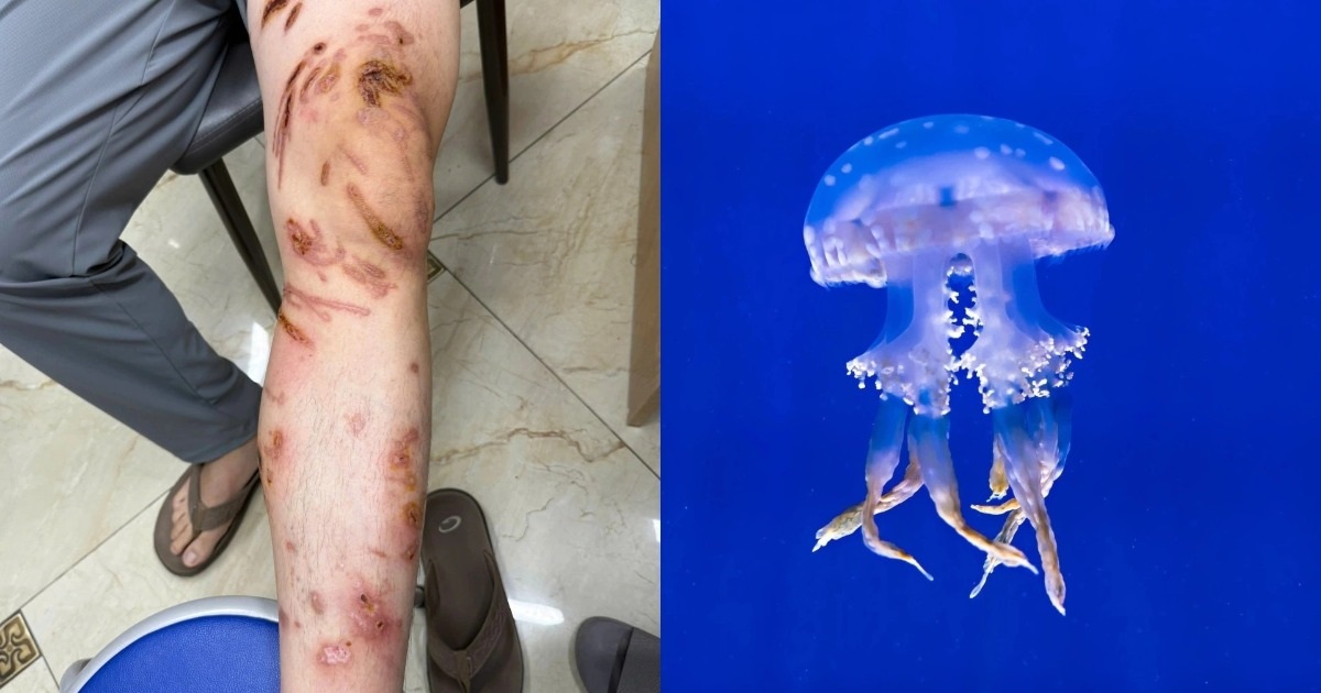 Bị Sứa Chích Khi Tắm Biển: Cách Xử Lý và Phòng Tránh Hiệu Quả Da loang lổ tổn thương vì bị sứa chích khi tắm biển