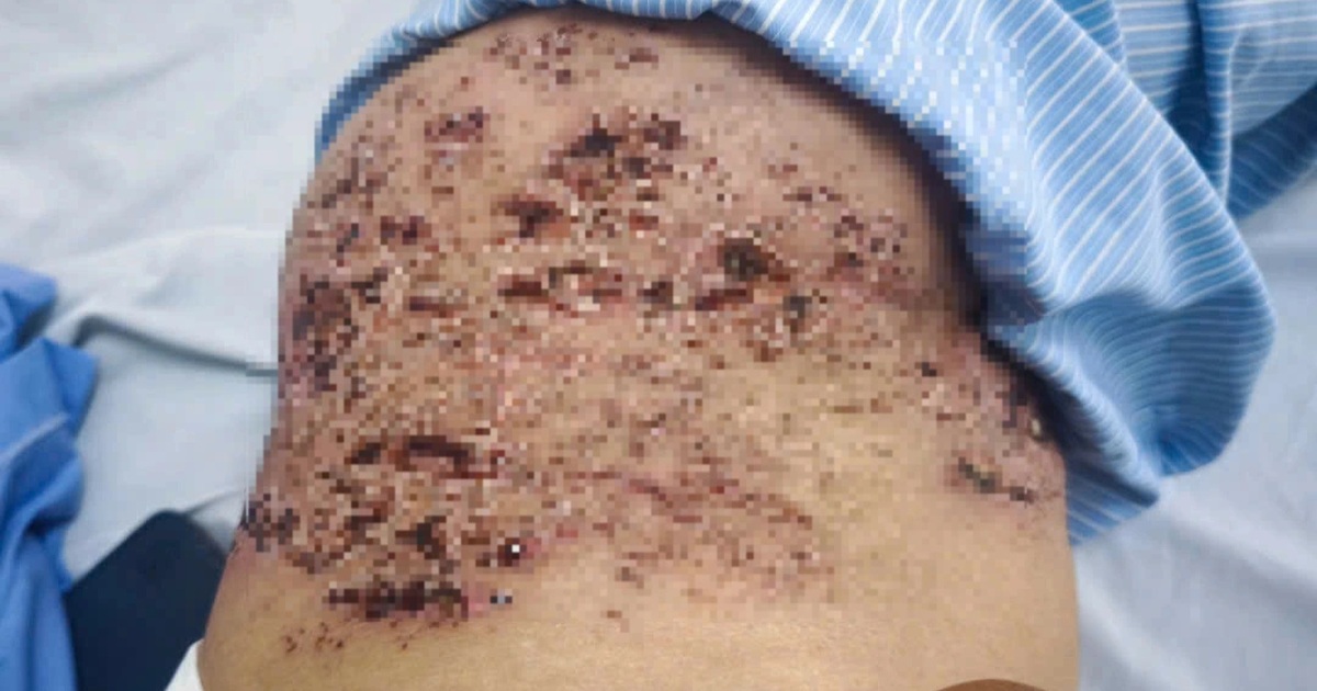 Zona Thần Kinh: Nguy Cơ và Biện Pháp Phòng Ngừa Hiệu Quả Da như tổ ong sau khi đắp đậu xanh chữa zona thần kinh