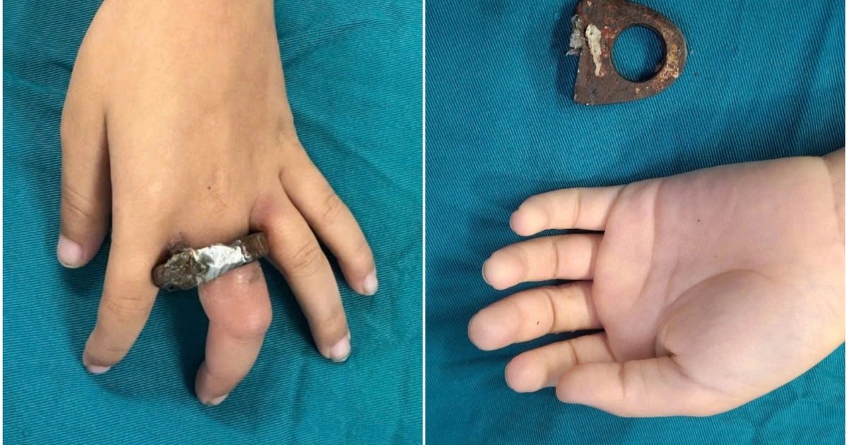 Hà Nội: Gia Đình Cưa Cổng Giải Cứu Bé Trai Kẹt Tay Trong Vòng Khóa Hà Nội: Gia đình cưa cổng giải cứu bé trai kẹt tay trong vòng khóa