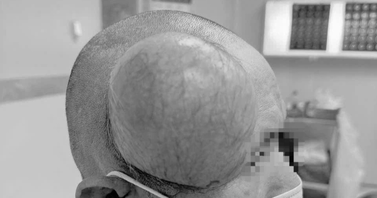 Phẫu thuật thành công khối u lớn trên đầu người đàn ông ở Đắk Lắk Khối u khổng lồ "mọc" trên đầu người đàn ông ở Đắk Lắk