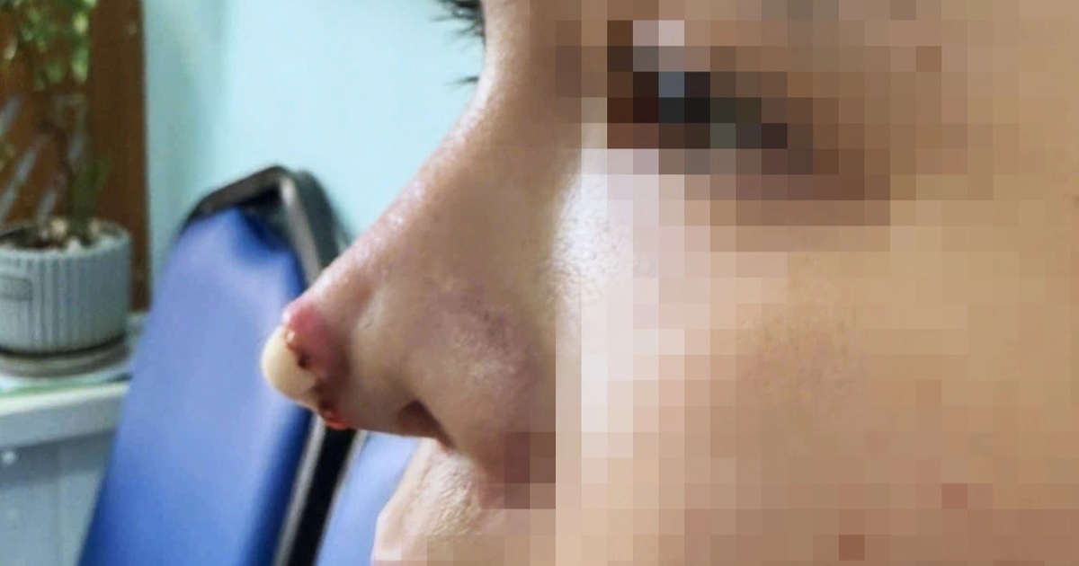 Hậu quả nặng nề sau khi nâng mũi tại TP.HCM TPHCM: Thêm 2 phụ nữ gánh hậu quả nặng nề sau khi nâng mũi