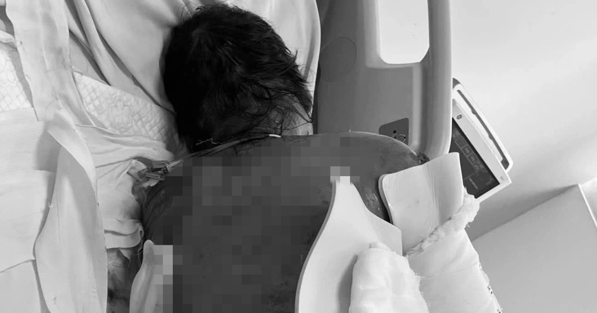 Hội chứng hiểm khiến người phụ nữ bong tróc da 92% sau khi dùng kháng sinh Hội chứng hiểm khiến người phụ nữ bong tróc da 92% sau khi dùng kháng sinh