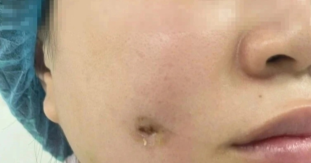 Nữ Bệnh Nhân Được Cứu Chữa Kịp Thời Sau Khi Nhiễm Trùng Do Tạo Má Lúm Đồng Tiền Tại Spa Người phụ nữ bị nhiễm trùng sau khi làm má lúm đồng tiền tại spa