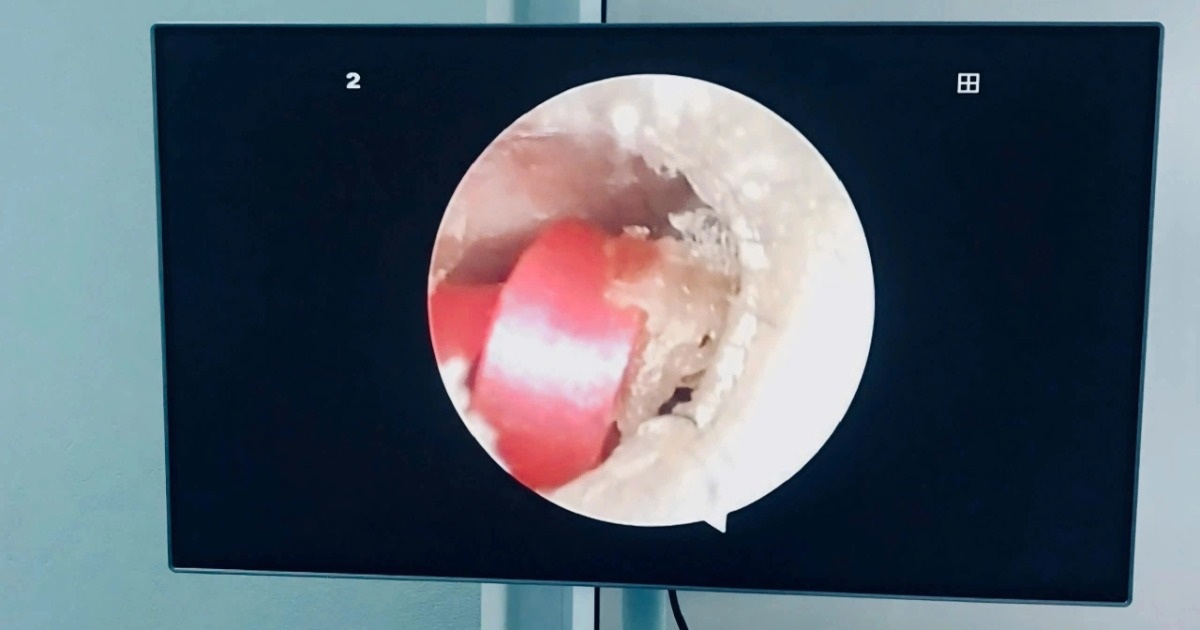 Bé gái suýt thủng màng nhĩ vì dây buộc tóc: Cảnh báo nguy cơ dị vật tai ở trẻ nhỏ Vừa nghỉ hè, bé gái đã suýt thủng màng nhĩ vì... dây buộc tóc