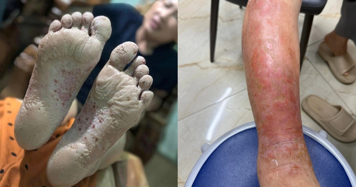 Cẩn trọng với bệnh vùng lũ: Một vết ngứa nhỏ có thể thành ổ nhiễm trùng Cẩn trọng với bệnh vùng lũ: Một vết ngứa nhỏ có thể thành ổ nhiễm trùng