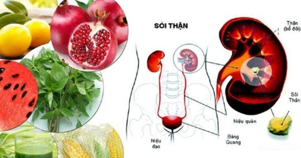 Biện pháp đơn giản hàng đầu giúp đẩy lùi sỏi thận Biện pháp đơn giản hàng đầu giúp đẩy lùi sỏi thận
