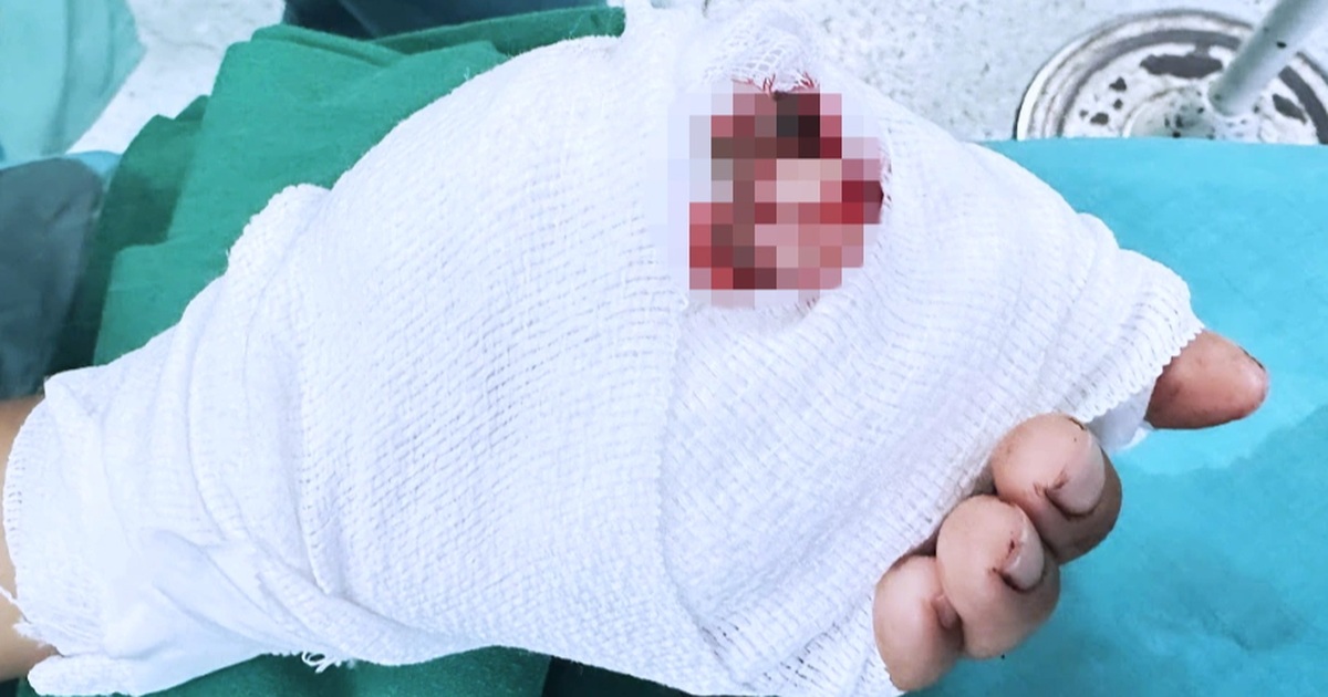 Đi cắt mì phụ giúp gia đình, bé trai 12 tuổi bị đứt hai ngón tay thương tâm Đi cắt mì phụ giúp gia đình, bé trai 12 tuổi bị đứt hai ngón tay thương tâm