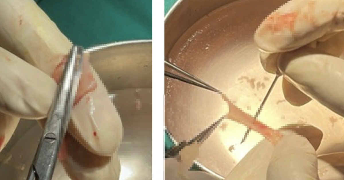 TPHCM: Bác sĩ dùng “da trong miệng” để… cứu đường tiểu chàng trai 29 tuổi TPHCM: Bác sĩ dùng "da trong miệng" để... cứu đường tiểu chàng trai 29 tuổi