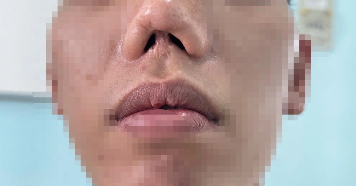 Chàng trai biến dạng mũi 31 năm, chịu nhiều cuộc mổ vì hậu quả lúc sơ sinh Chàng trai biến dạng mũi 31 năm, chịu nhiều cuộc mổ vì hậu quả lúc sơ sinh