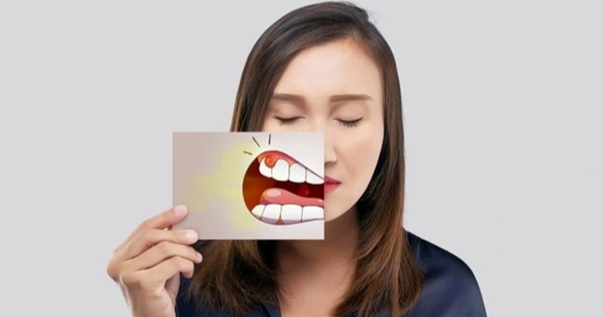 Cô gái mọc sùi mào gà ở miệng Cô gái mọc sùi mào gà ở miệng