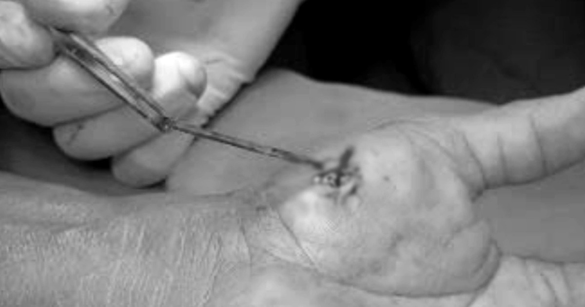 Người đàn ông ngỡ ngàng khi phát hiện “vật thể lạ” 4cm gây nguy hiểm ở tay Người đàn ông ngỡ ngàng khi phát hiện "vật thể lạ" 4cm gây nguy hiểm ở tay