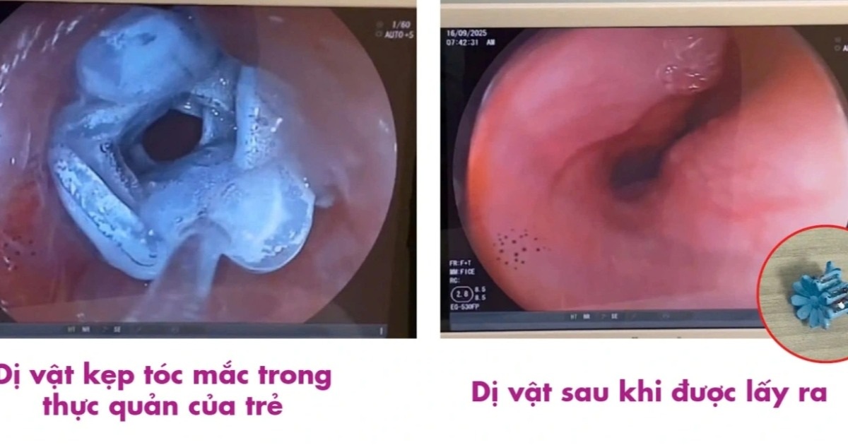 Nuốt phải kẹp tóc, bé gái 5 tuổi nhập viện cấp cứu Nuốt phải kẹp tóc, bé gái 5 tuổi nhập viện cấp cứu