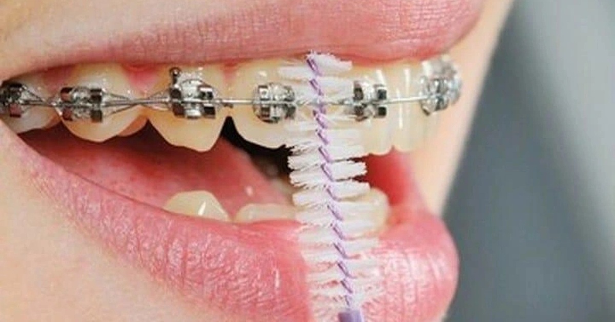 Sai lầm khi niềng răng nhiều người Việt mắc phải Sai lầm khi niềng răng nhiều người Việt mắc phải
