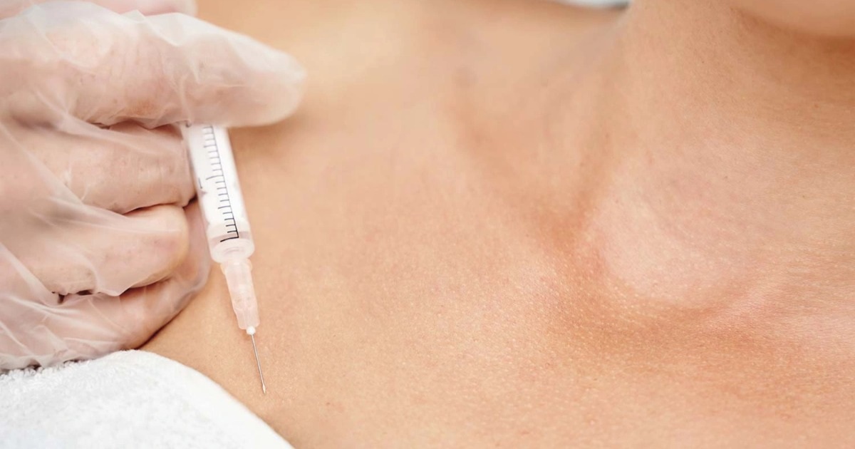Sau nâng ngực, người phụ nữ hốt hoảng khi bác sĩ hút ra hơn 2 lít dịch viêm Sau nâng ngực, người phụ nữ hốt hoảng khi bác sĩ hút ra hơn 2 lít dịch viêm