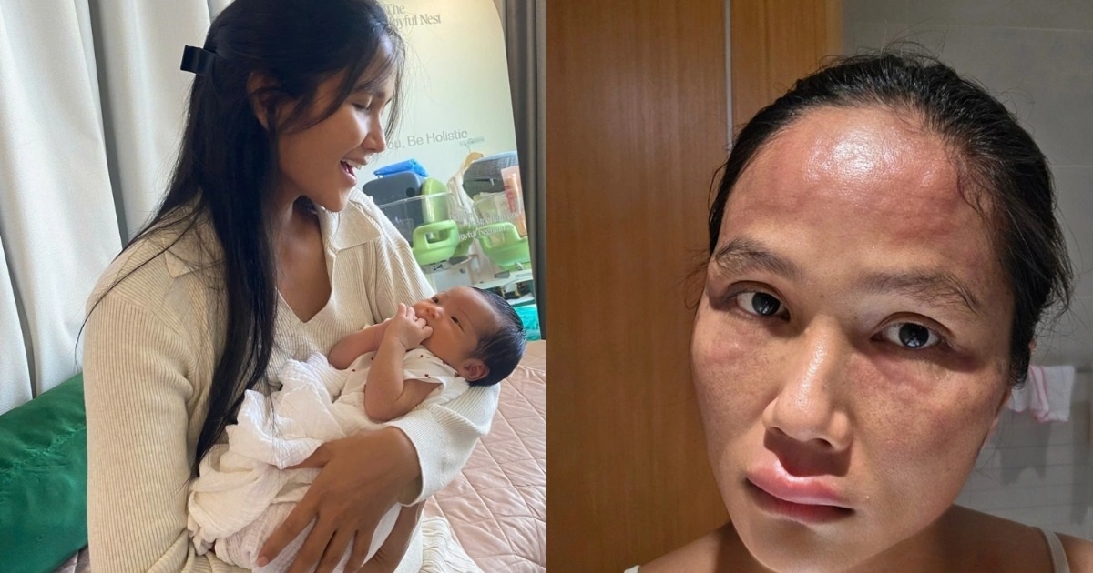 H'Hen Niê hé lộ gương mặt sưng tấy sau khi sinh, sức khỏe hiện ra sao?