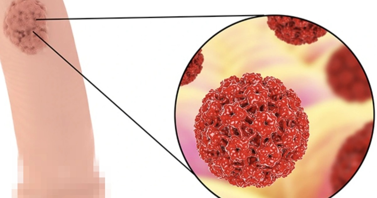 Nhiều người trẻ bị ung thư hiếm gặp: Vaccine có giúp thoát bệnh? Nhiều người trẻ bị ung thư hiếm gặp: Vaccine có giúp thoát bệnh?