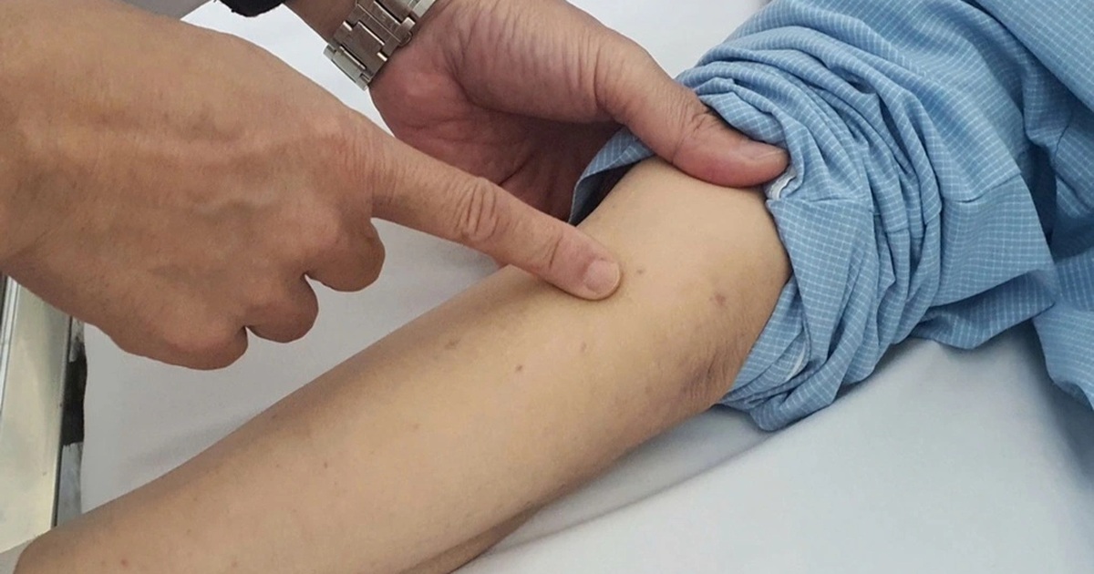 Tăng ca viêm màng não do não mô cầu, 82 người mắc trong 9 tháng Tăng ca viêm màng não do não mô cầu, 82 người mắc trong 9 tháng