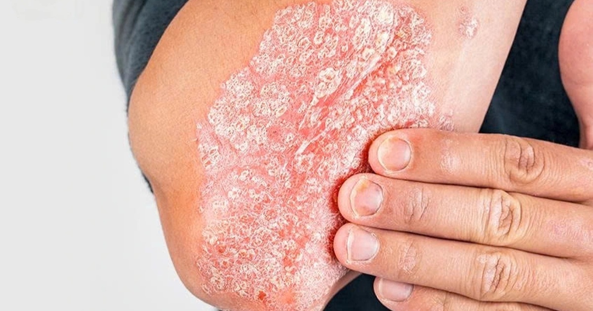 Tự điều trị bệnh da, người đàn ông nằm cáng vì tổn thương khớp nghiêm trọng