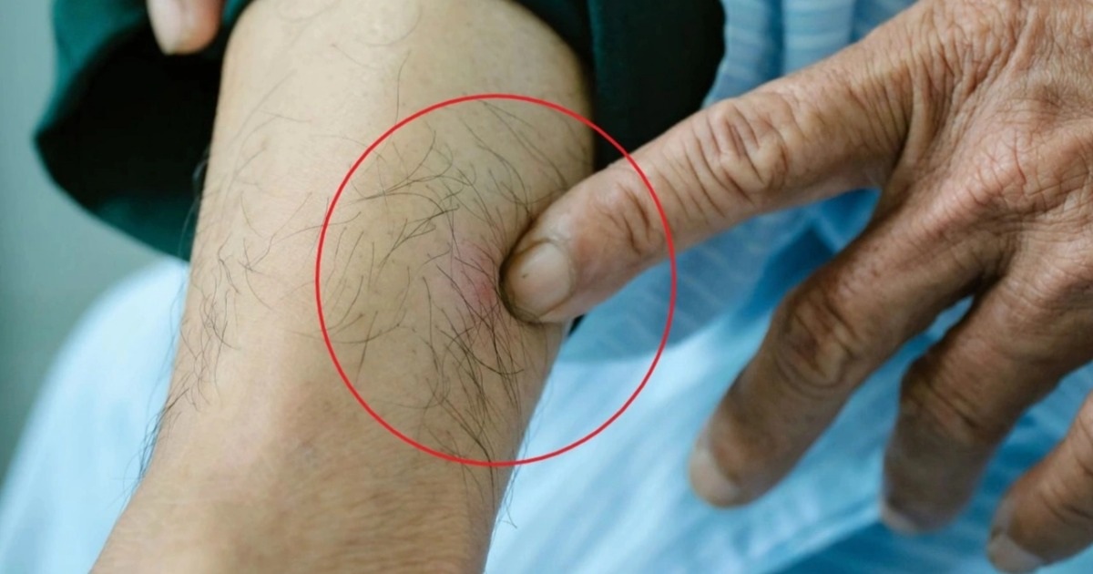Vì sao sốc phản vệ nguy kịch vì kiến ba khoang đốt? Vì sao sốc phản vệ nguy kịch vì kiến ba khoang đốt?