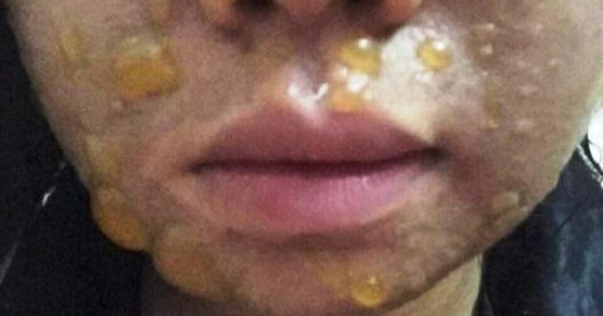 Nhiều người nhập viện vì mặt sưng húp, sạm đen sau peel da theo mạng xã hội