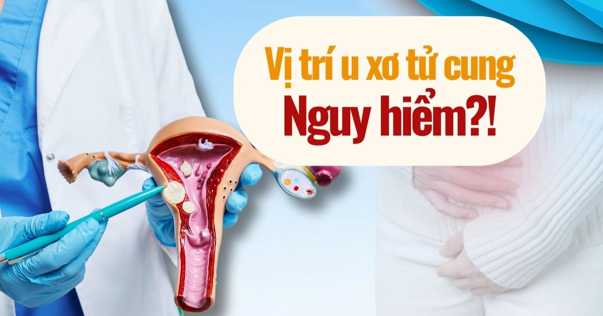 U xơ tử cung nhỏ nhưng vẫn nguy hiểm nếu nằm ở vị trí nhạy cảm