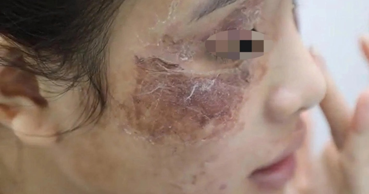 Cô gái gặp "họa" vì thoa kem mua trên mạng giá 600.000 đồng