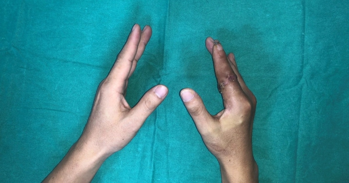 Lần đầu tiên tại Việt Nam, ngón tay đứt rời 25 giờ được nối thành công