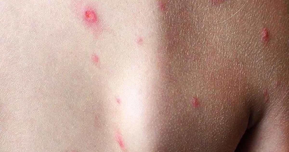 Một tỉnh phía Nam ghi nhận ca mắc đậu mùa khỉ đầu tiên