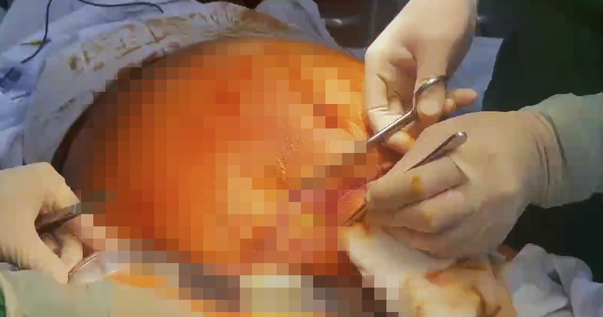 Người phụ nữ thủng ruột nguy kịch sau hút mỡ, 81 ngày chống chọi tử thần