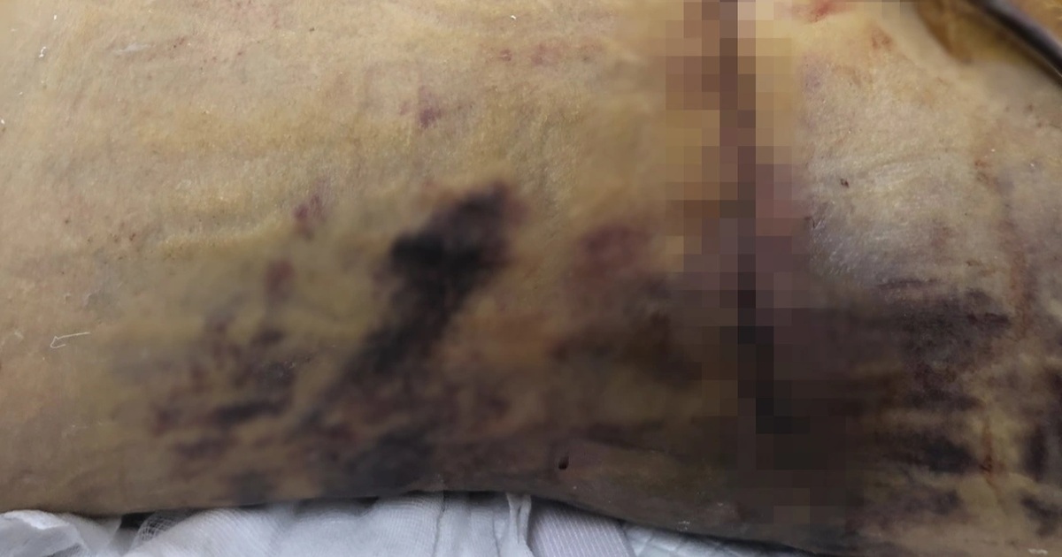 Nữ Việt kiều 60 tuổi tử vong vì biến chứng nặng sau khi hút mỡ, nâng ngực